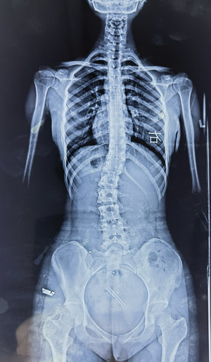 脊柱侧弯的X线检查