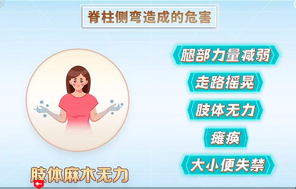 脊柱侧弯造成的危害