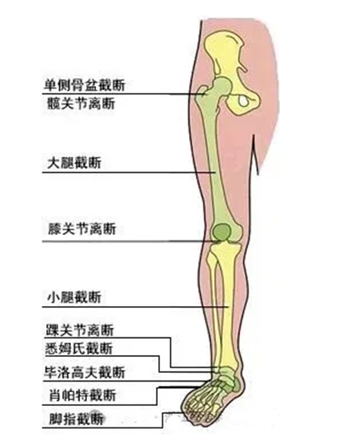 下肢截肢部位名称
