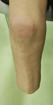 截肢者