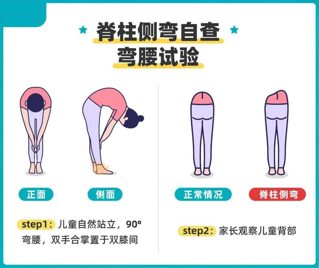 脊柱侧弯与家庭自查