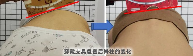 脊柱侧弯支具穿戴3个月要及时复查