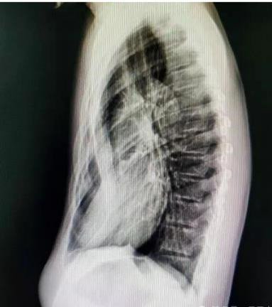 漏斗胸怎么矫正？