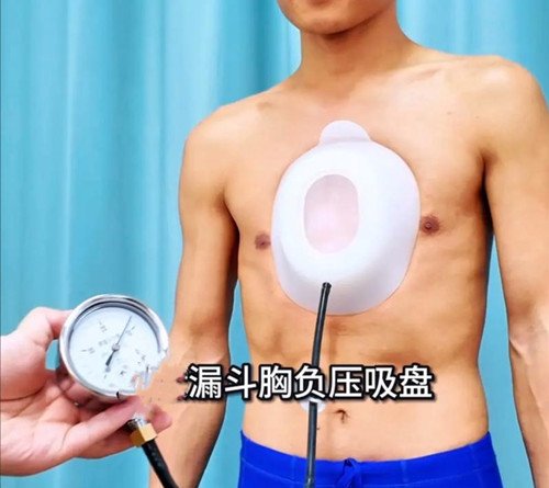 漏斗胸怎么矫正？
