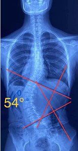 睡姿对脊柱侧弯患者的影响