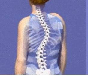 成人脊柱侧弯怎么办？