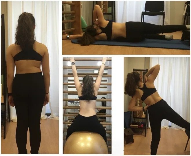 成人脊柱侧弯怎么办？