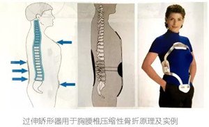 矫形器可以矫正或稳定肢体畸形