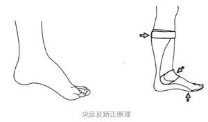 矫形器可以矫正或稳定肢体畸形